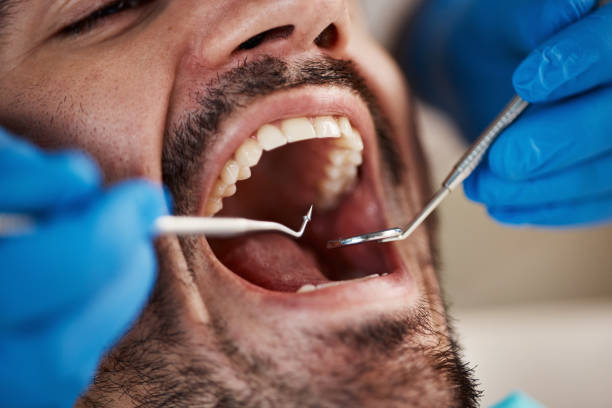 Teeth Whitening in MO